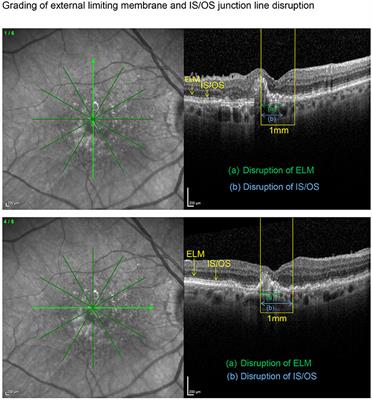 External Limiting Membrane Disruption Predicts Long-Term Outcome in Strict Treat-And-Extend Regimen in Neovascular Age-Related Macular Degeneration